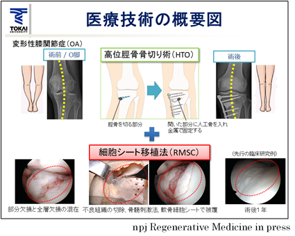 自己細胞シートによる軟骨再生治療」が厚生労働省先進医療会議で「適